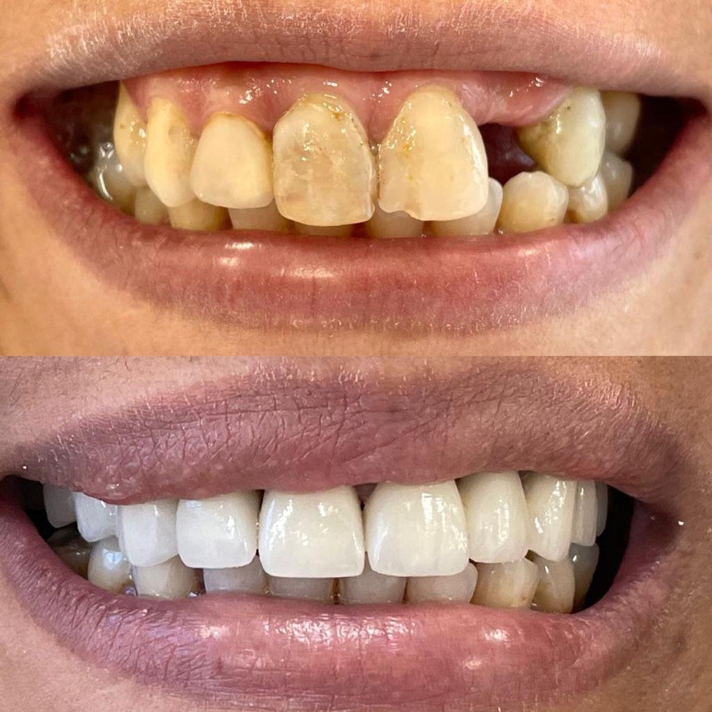 Implante dentário